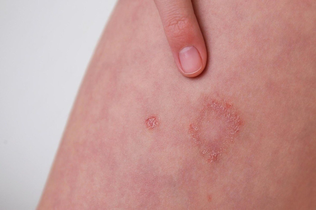 child-has-allergic-contact-dermatitis-skin_104376-1996