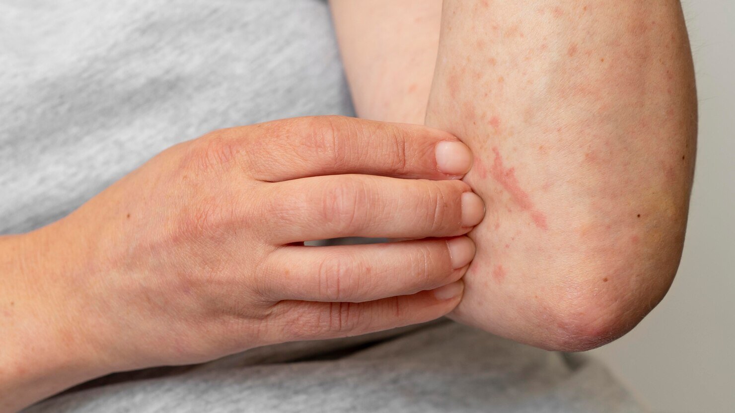 skin-allergy-reaction-person-s-arm_23-2149140477