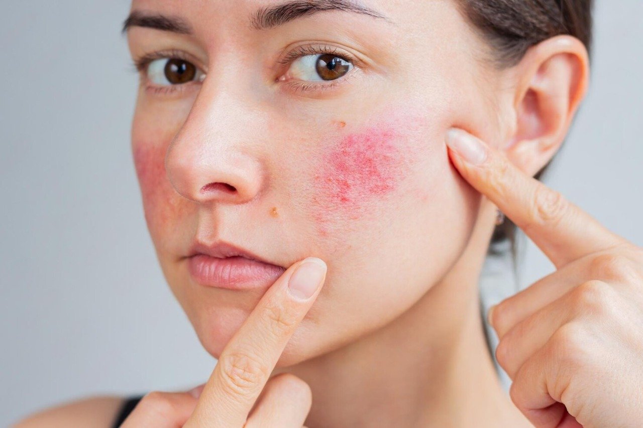 woman-suffering-from-rosacea-her-face-acute-stage-she-showing-redness-her-cheek_753567-1024