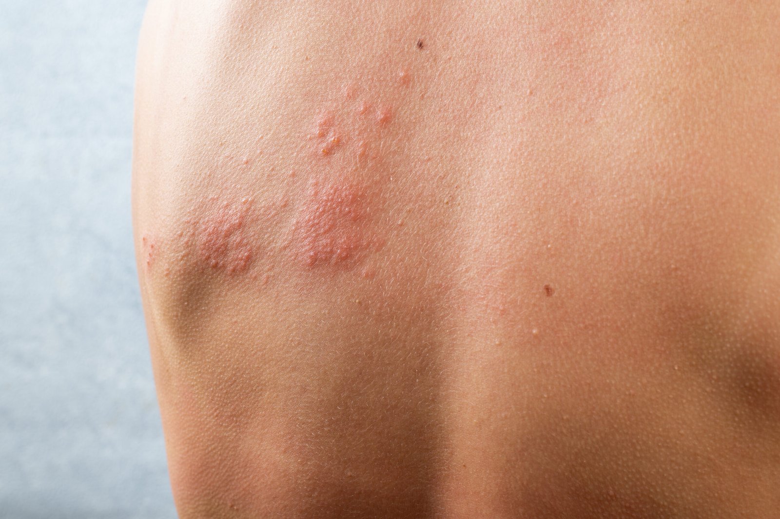 Dermatitis_OK
