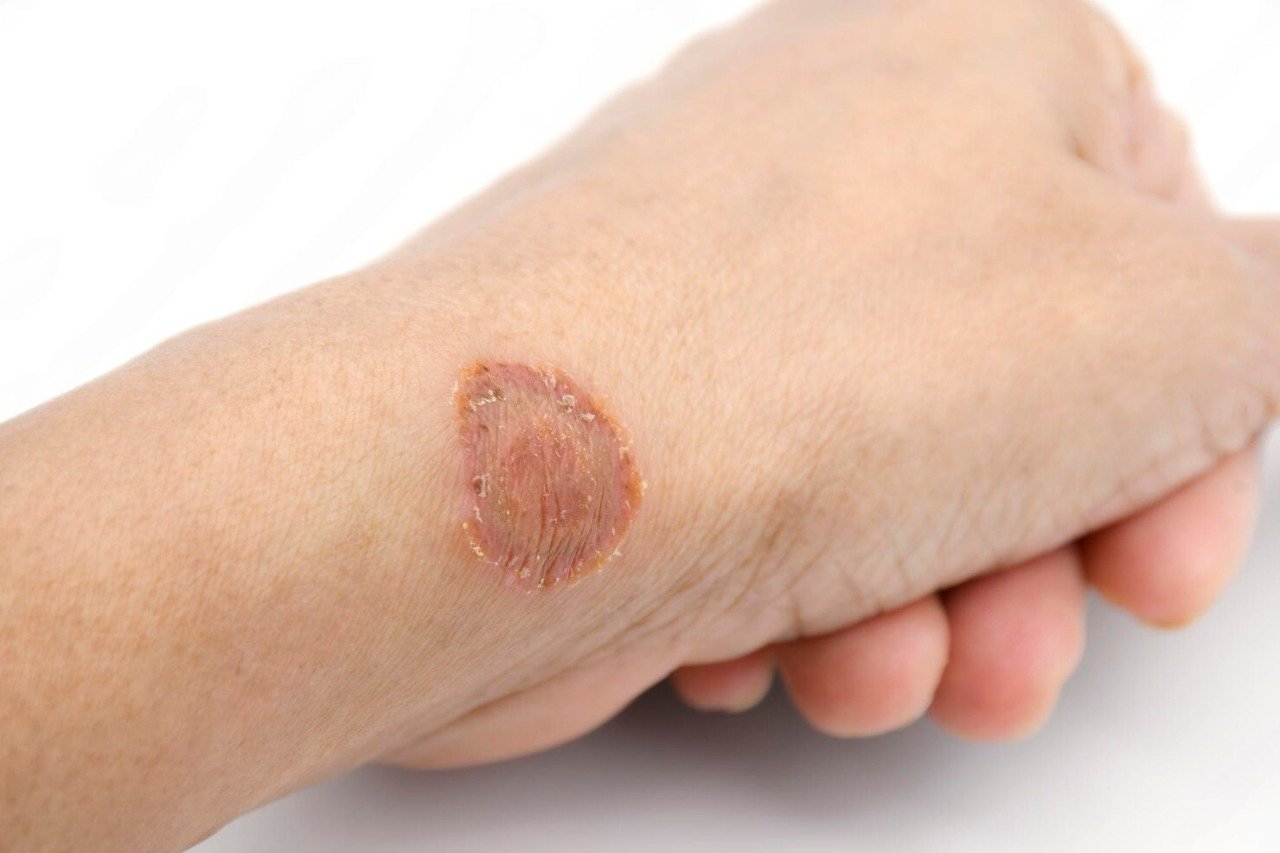microsporum-canis-lesion-fungus-infections-human-skin-transmitted-by-contact_36049-1798
