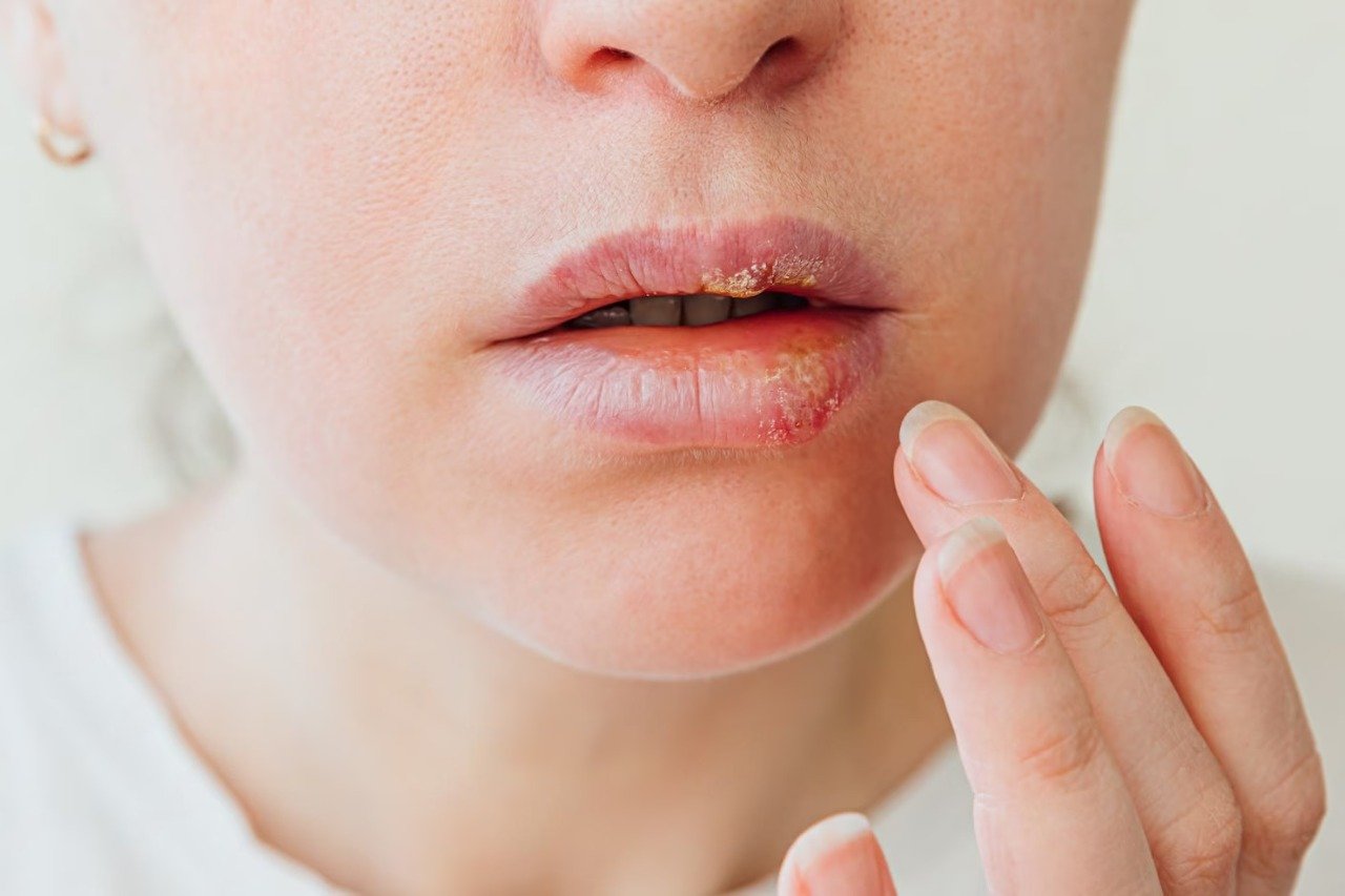 part-young-woman-face-with-finger-touching-pain-lips-with-herpes-affected-beauty-dermatology-concept_80942-5275
