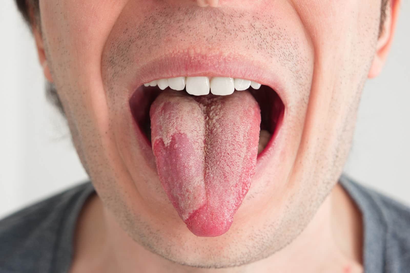 prevention-tips-for-thrush-maintaining-good-oral-hygiene
