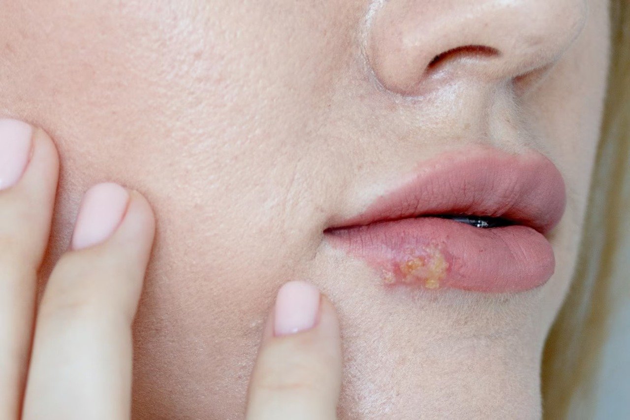 woman-with-virus-herpes-lips-herpes-lips-young-woman_222877-10561